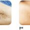 Laser hair removal