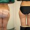 Liposukce