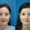 Plastika nosu (Rhinoplastika)