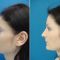 Plastika nosu (Rhinoplastika)