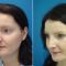 Plastika nosu (Rhinoplastika)