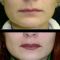 Lip augmentation - cheiloplasty