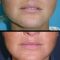 Lip augmentation - cheiloplasty