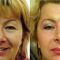 Blefaroplastie