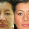 Blefaroplastie