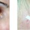 BOTOX® / DYSPORT®, Botulina - pentru îndepărtarea ridurilor.