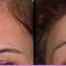 Lifting facial