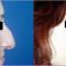 Rinoplastie