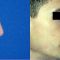Rinoplastie