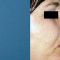 Rinoplastie