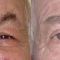Blefaroplastie