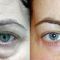 Blefaroplastie