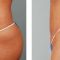 Alternatywa liposukcji – nieinwazyjne usuwanie tłuszczu i cellulitu