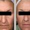 Fotorejuvenation