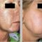 Fotorejuvenation