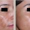 Fotorejuvenation