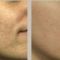 Laser acne treatment