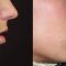 Lip augmentation - cheiloplasty