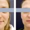 Rhinoplasty (Nose Job)