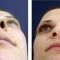 Rhinoplasty (Nose Job)