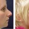 Rhinoplasty (Nose Job)