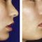 Lip augmentation - cheiloplasty