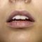 Lip augmentation - cheiloplasty