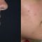 Lip augmentation - cheiloplasty