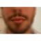 Aumento labbra