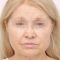 Facelift, SMAS facelifting