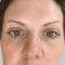 Eyelid surgery (Blepharoplasty)