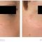 Laser Scar Treatment