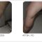 Varicose veins laser treatment