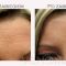 BOTOX®