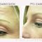 BOTOX®