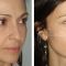 Injekcijska punila - Dysport, Restylane, Botox, Bio Alcamid…