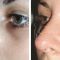 Injekcijska punila - Dysport, Restylane, Botox, Bio Alcamid…