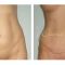 Abdominoplastika (zatezanje kože trbuha)
