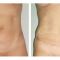 Abdominoplastika (zatezanje kože trbuha)