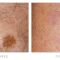 Tattoo removal