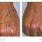 Tattoo removal