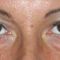 Korekcja powiek (Blepharoplastyka)