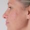 Age Spots Treatment