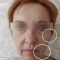 Ultherapy