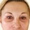 Operace čela (Forehead lift)