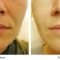 Facelift Silhouette Soft