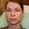 Laser acne treatment