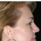 Cirugía de párpados (Blefaroplastia)
