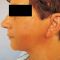 Facelift (operace obličeje), SMAS lifting