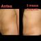 Abdominoplastia